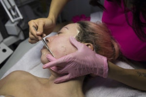 Dermaplaning